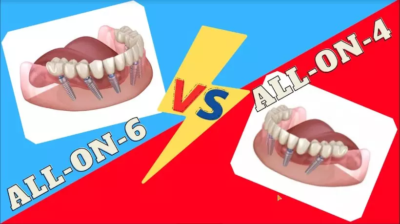 Чем отличается имплантация зубов all-on-4 от all-on-6?