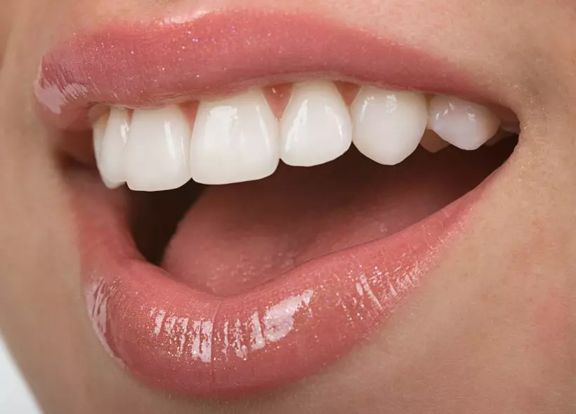 красивые зубы при использовании виниров