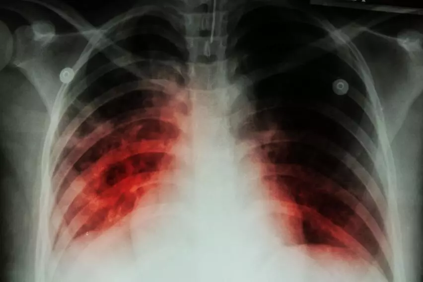 Вторичные формы туберкулеза легких