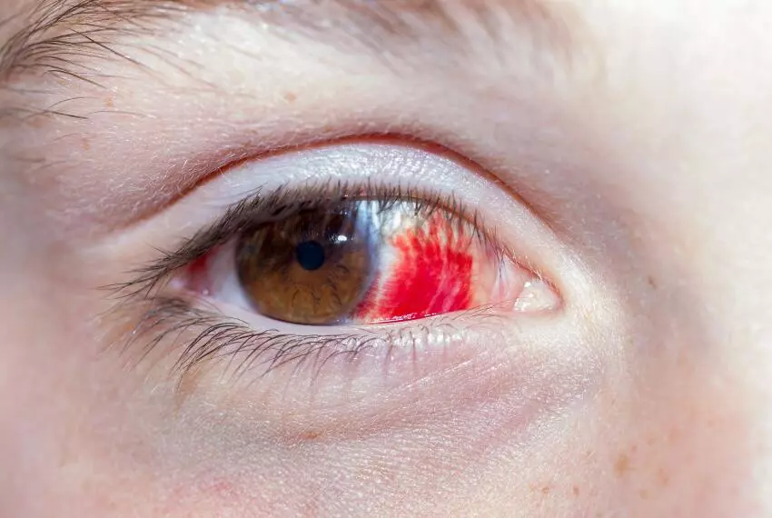 Гифема – кровоизлияние в глаз