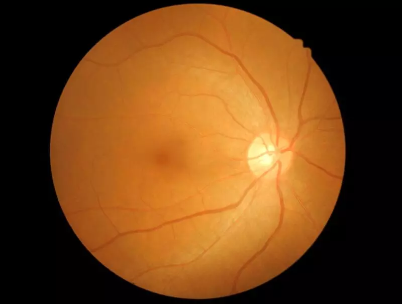 Кисты в сетчатке (ретиношизис)
