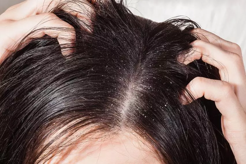 5 способов справиться с повышенным потоотделением кожи головы